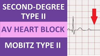 SecondDegree Type 2 Heart Block ECG Rhythm Nursing NCLEX  Mobitz Type II [upl. by Viridi]