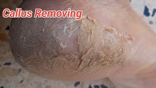 Foot Care  callus Removing callusremoval diy asrm fyp trendingvideo trending [upl. by Faustina876]