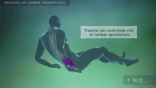 What Causes Lower Back Pain  Degenerative Disc Disease  Treatment for Lumbar Spondylosis [upl. by Manlove]