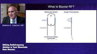 Utilizing Radiofrequency Ablation to Treat Metastatic Bone Disease A CaseBased Presentation [upl. by Ahcirt128]