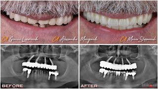 Intra Oral Scan flowJig deprogrammer Michigan Bite Monolithic Zirconia Toronto bridge [upl. by Cirtemed]