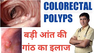 Colorectal Polyps  Symptoms Causes amp Medicine  Polyps in Hindi  Polyps Treatment in Homeopathy [upl. by Nelson585]