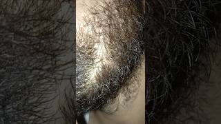 Ingrown hair longer satisfying ingrownhair hairstyle satisfyingviralshort viralshorts [upl. by Arraek]