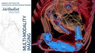 Imaging the Patient with LVAD Mahwash Kassi MD and Su Min Chang MD February 5 2019 [upl. by Enaols]