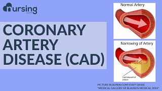 What is Coronary Artery Disease And how do you treat it as a Nurse Nursing School Lesson [upl. by Meehyr]