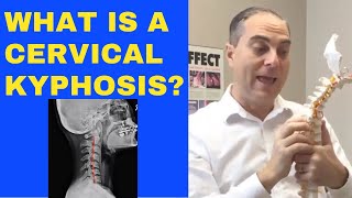 What Is Cervical Kyphosis Reversed Curve of Neck And How Can It Be Treated  Dr Walter Salubro [upl. by Schrader120]