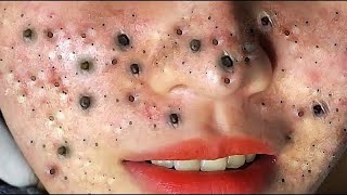 Big Cystic Acne Blackheads Extraction Blackheads amp Milia Whiteheads Removal Pimple Popping  614 [upl. by Aliled]