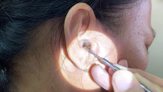 Massive Hard Dry Earwax Removed from Womans Ear [upl. by Ewell]