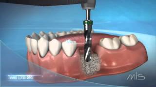 Procedimiento de colocación de implante dental MIS El Salvador [upl. by Swope194]