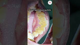 Is dental scaling harmful dentalscaling toothcleaning [upl. by Assyn]