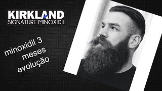 Minoxidil para a barba  3 meses evolução [upl. by Anyaled]