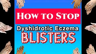 HOW I STOPPED DYSHIDROTIC ECZEMA AND BLISTERS FOR GOOD [upl. by Akirehc419]