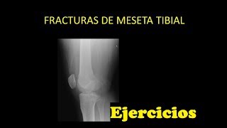 Fractura de Meseta Tibial  Ejercicios que puedes hacer en casa [upl. by Hagile]