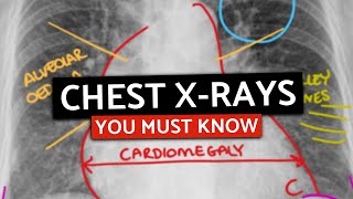 10 MUST KNOW Chest XRays For MedicalPA Finals  CXRs Made Easy [upl. by Cardew]