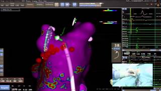 Ablación de Fibrilación Auricular Caso en vivo por el Dr Antonio Berruezo [upl. by Shirline]