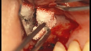 Sinus augmentation using OSTEON™ 3 Collagen DrTeddys commentary [upl. by Nimzaj505]