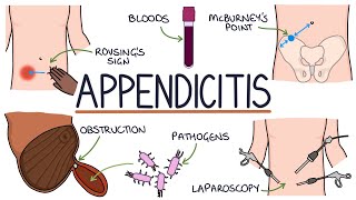 Understanding Appendicitis [upl. by Tamera412]