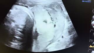 Ultrasound of Placental abruption [upl. by Elyagiba]