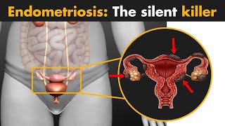 Endometriosis  What you need to know [upl. by Alger]