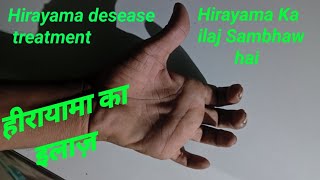 Hirayama desease Hindi part 2  hirayama desease ka Ilaj kya hai [upl. by Dyanne]