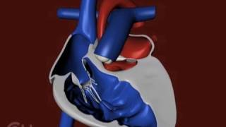 Hypoplastic Left Heart Syndrome HLHS  Pediatric Nursing [upl. by Ezitram]