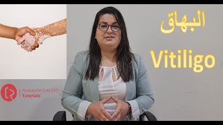 Vitiligo  البهاق [upl. by Sible]