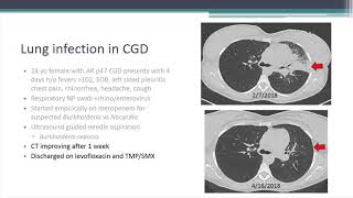 Lung InflammationGranuloma Problems with CGD [upl. by Mahla]