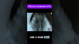 Fibrous Dysplasia FD [upl. by Lait307]