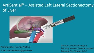 Artisential  assisted Left Lateral Sectionectomy [upl. by Ignacio]