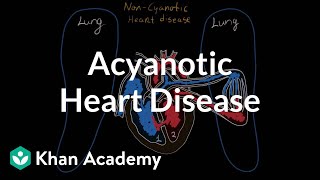 What is acyanotic heart disease  Circulatory System and Disease  NCLEXRN  Khan Academy [upl. by Cleavland]