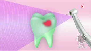 Santé  Un nouveau traitement ciblé pour mieux traiter les caries [upl. by Damian37]