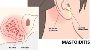 MastoiditisIntroduction of mastoiditis  Definition of mastoiditis Classification of mastoiditis [upl. by Horick525]