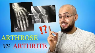 Arthrose et arthrite  les différences causes symptômes traitements [upl. by Ardeid]