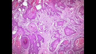 Neoplasia II Malignant epithelial tumors histopathology slides [upl. by Novahs281]