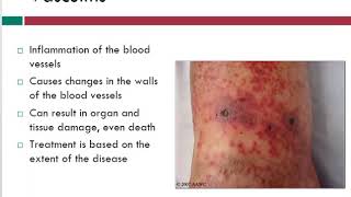 Vasculitis  Info About Vein Problems  WoundEducatorscom [upl. by Kroo]