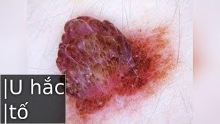 Các loại melanocytic neoplasms [upl. by Eelreveb]