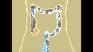 Colon Hydrotherapy in Pune  Constipation Treatment  Piles Treatment  Detox  Colon Cleansing IBS [upl. by Noxas]