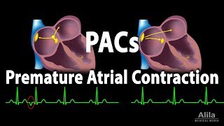 Premature Atrial Contractions PACs Animation [upl. by Tnert]