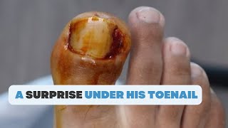 WHAT IS THIS SURPRISE UNDER HIS TOENAIL [upl. by Squire]