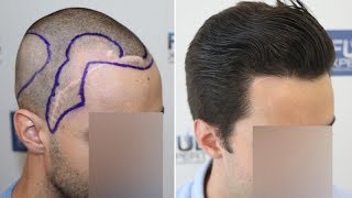 FUE Hair Transplant 2516 Grafts NW III A By Dr Juan Couto  FUEXPERT CLINIC Madrid Spain [upl. by Ema963]