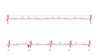 Pacemaker Issues Explained Part 3 Navigating Oversensing [upl. by Koeppel]