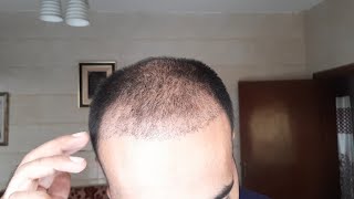 Shedding Phase after Hair Transplant  FEAR or NOT  Hindi Urdu [upl. by Aitnecserc]