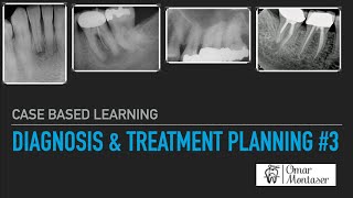 Case Based Learning Diagnosis and Treatment Planning in Endodontics 3 [upl. by Kitrak754]