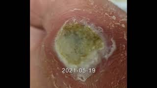 Super Big plantar wart removal with duct tape Endwarts within 5 months 큰 족저 사마귀 5개월 만에 완치 [upl. by Aerdnwahs]