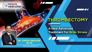 Thrombectomy New Advanced Treatment for major brain strokes Dr Suresh Giragani [upl. by Edahsalof]