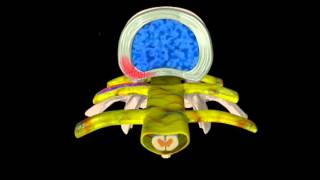 How Spinal Traction Helps Disc Decompression and Relieve Back or Neck Pain [upl. by Enneira512]