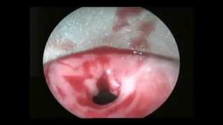 Stricture oesophagus in a 2 yr old  BALLOON DILATATION WITH MITOMYCIN APPLICATION [upl. by Airretal]