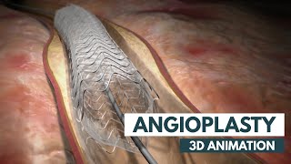 Angioplasty  3D Animation  Real Footage [upl. by Enelkcaj931]