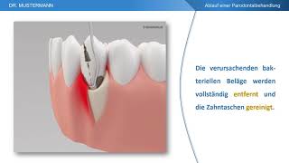 Ablauf der Behandlung  Parodontalbehandlung [upl. by Amocat]