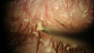 Demodex Blepharitis Plaque Removal with Forceps  Eyelash Mite at 539 [upl. by Neumeyer]